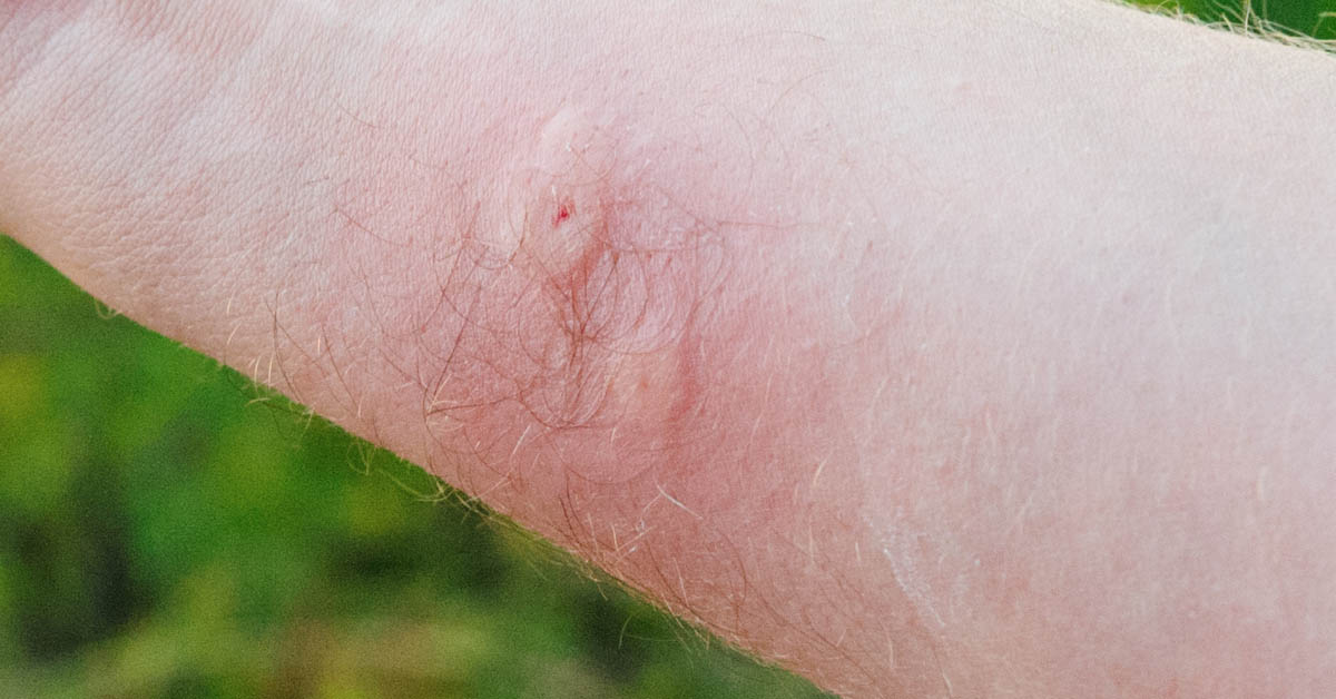 what does a brown recluse bite first look like