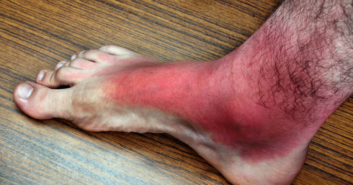 cellulitis toe