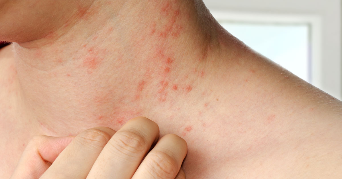 Dermatitis Treatment Online Amwell For Patients