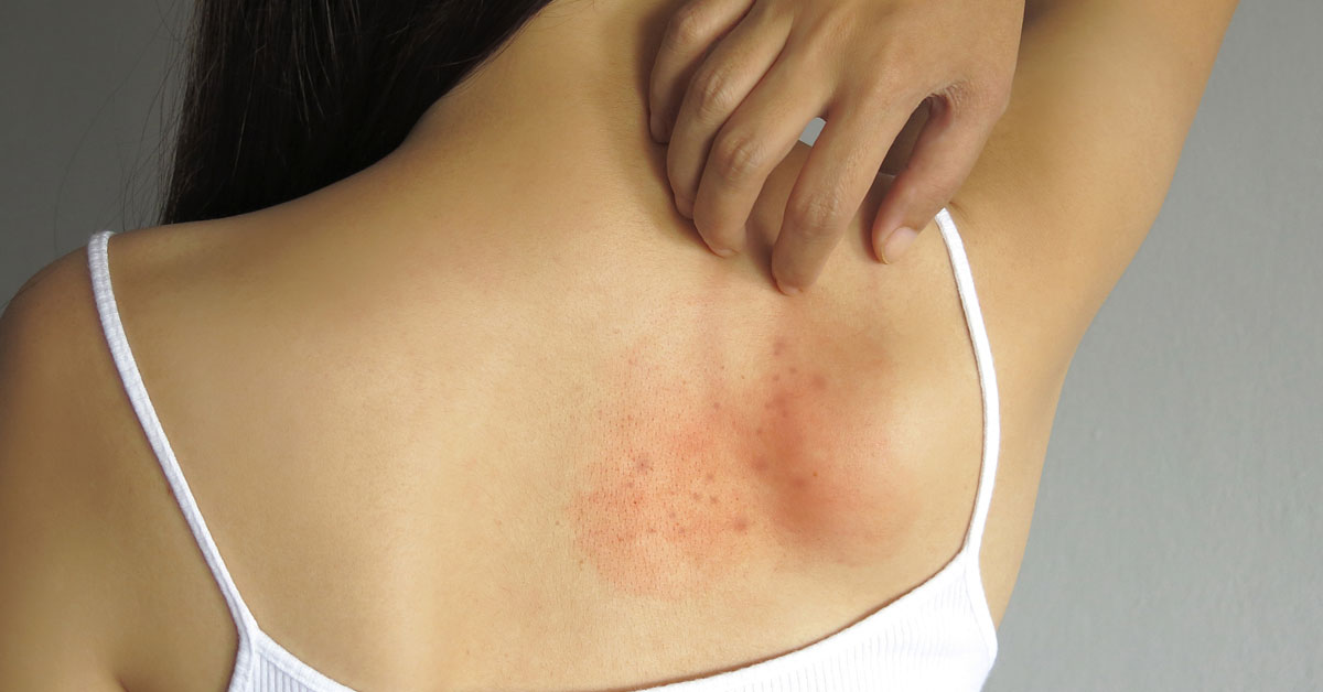 Can I Treat My Rash With Over-the-Counter Medication?: Advanced