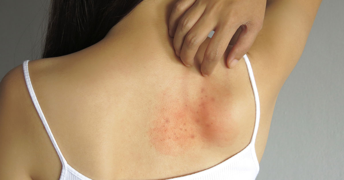 Hives while Breastfeeding: Treatment & Home Remedies