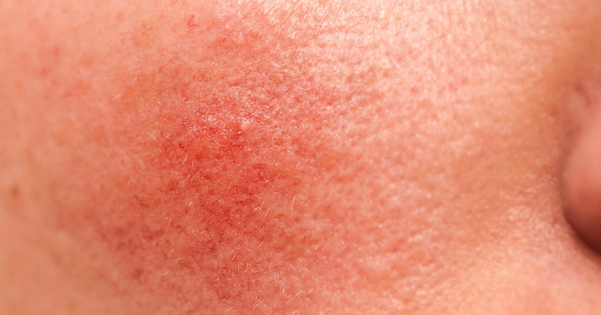 Rosacea